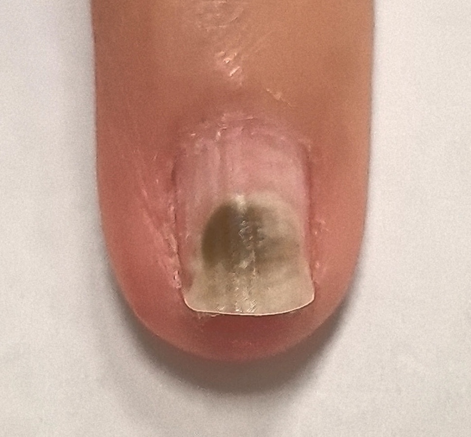 Нижегородка подхватила жуткую инфекцию из-за маникюра - фото 2