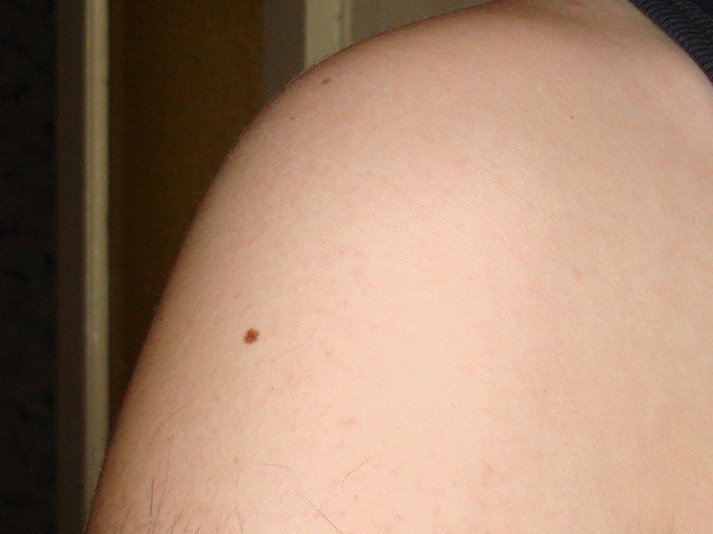 Врачи назвали главные признаки зарождающегося рака кожи - фото 1